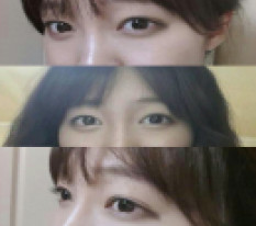 เคยกังวลเรื่องผ่าตัดแก้เยอะมาก.. ตอนนี้ดวงตาสวยและมั่นใจเต็มที่♥
