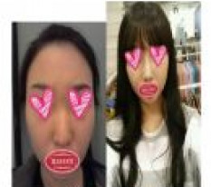 ผ่าตัดจมูกแล้วกลายเป็นผู้หญิงจมูกโด่งเลยค่ะ~
