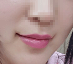 มาโพสต์รีวิวศัลยกรรมมุมปาก~