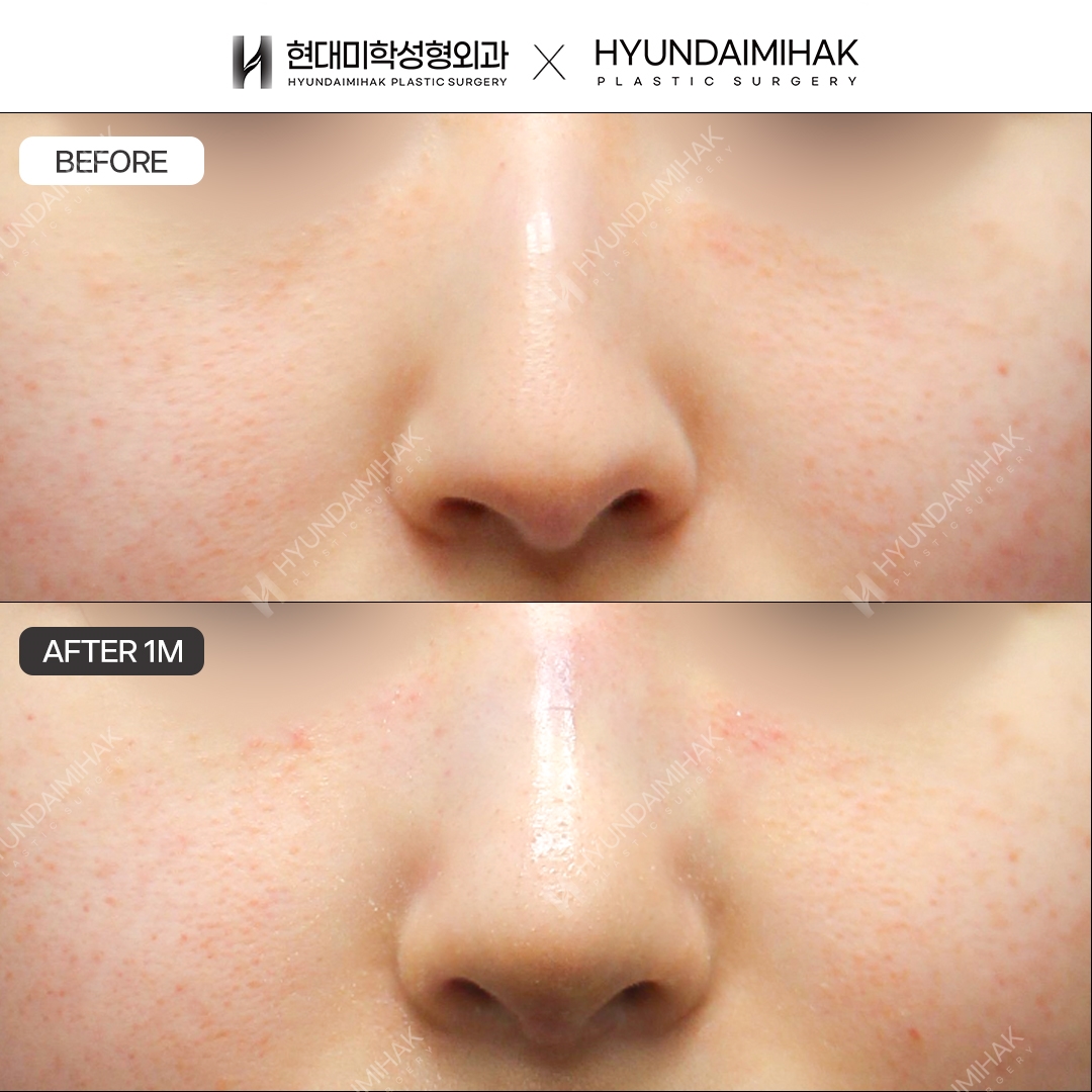 [ศัลยกรรมแก้จมูกฮัมพ์] สันจมูก + ปลายจมูก หลังทำ 1 เดือน