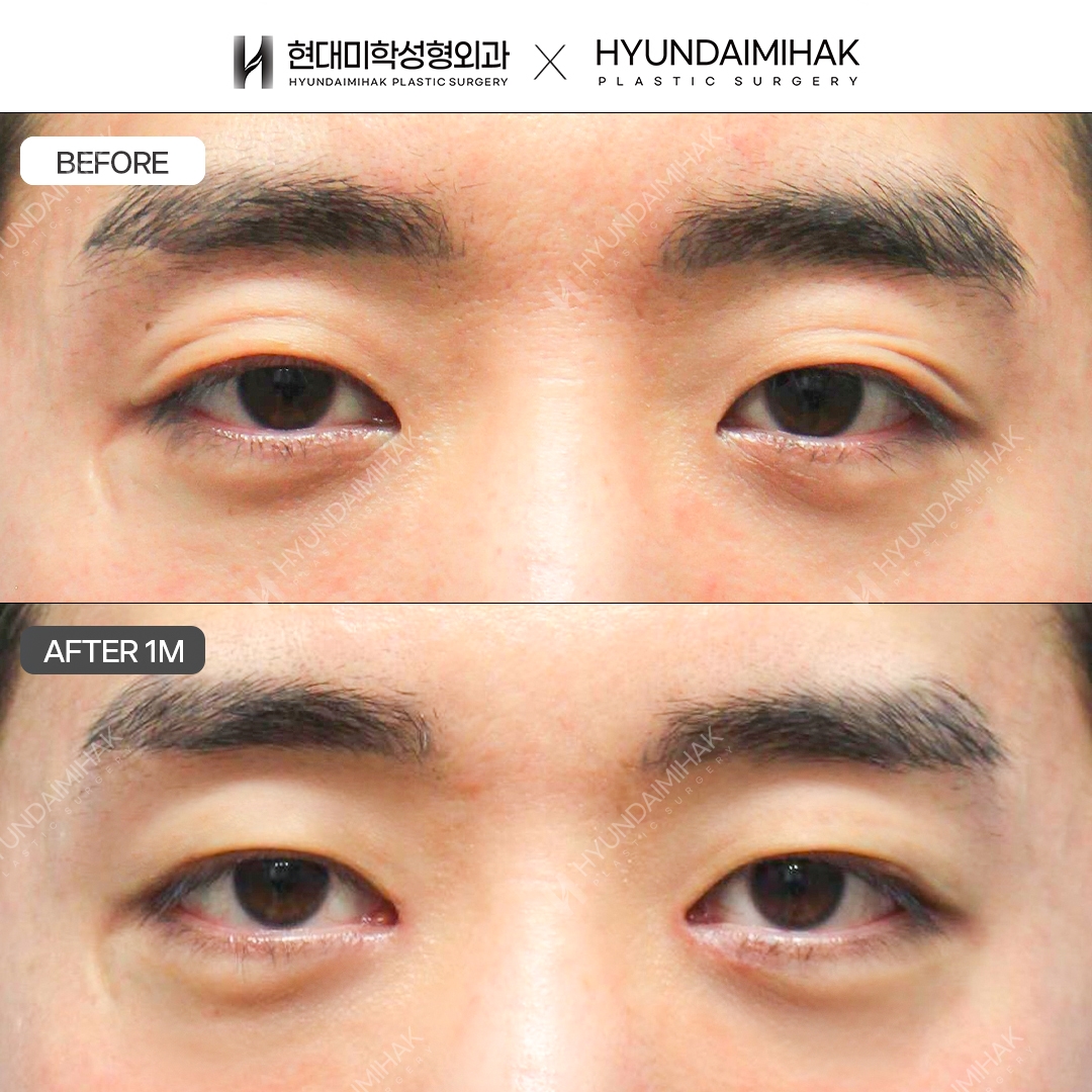 [ศัลยกรรมตาผู้ชาย] แก้กล้ามเนื้อตาแบบไม่กรีด + เปิดหัวตา