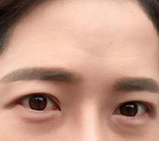 ผมทำตาสองชั้นและปรับกล้ามเนื้อตาครับ