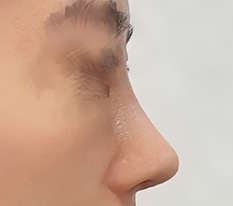 From a low nose to a natural straight-slope nose