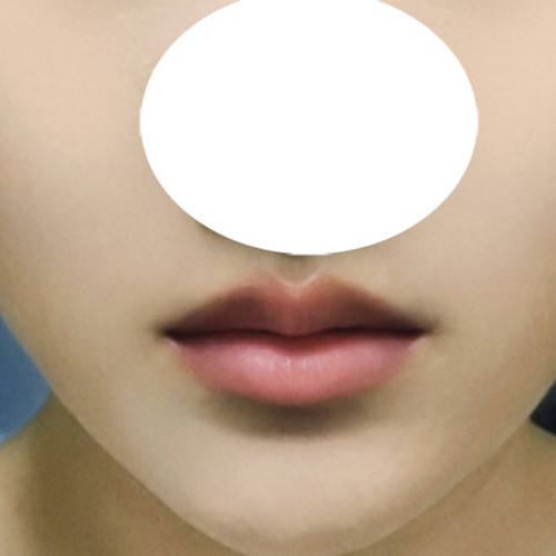 กังวลริมฝีปากบนหนา แก้ด้วยทรง Cupid line