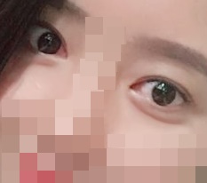 แก้ไขตา + แก้ตาหนัง