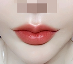 มุมปากสวยขึ้นแล้ว lol