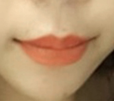 ศัลยกรรมยกมุมปากที่พอใจที่สุด :-)