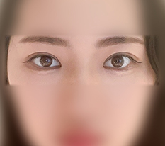 ตาสองข้างที่ไม่เท่ากันเข้าที่แล้ว ㅋㅋ