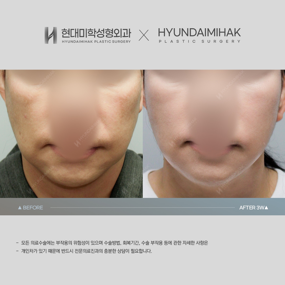 [ศัลยกรรมหน้าเด็ก] ร้อยไหม 3 สัปดาห์