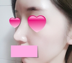 รีวิวแก้จมูก~~