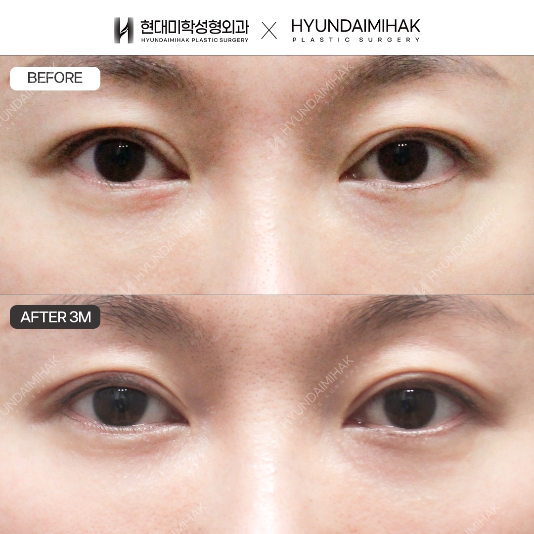 [ศัลยกรรมตาแก้ไข] กรีดทำตาสองชั้น + แก้กล้ามเนื้อตา