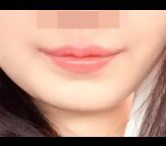 ศัลยกรรมมุมปากน่าประหลาดใจมากเลยค่ะ