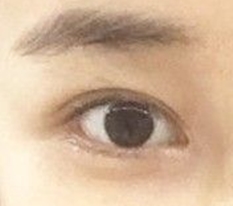 แก้ตาสองชั้นแล้วไลน์กลับมาสวย..ฮือ