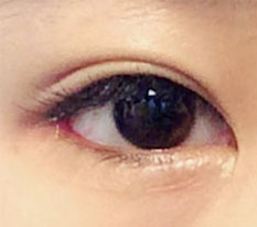 ผ่าแก้ไขหางตาและผ่าใต้ตาเป็นยังไงบ้าง?!