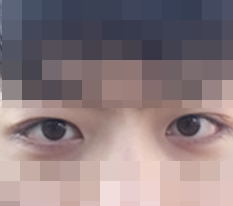 ตาสองชั้นที่อยากมี