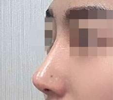 ทำจมูกแล้วมีคนบอกว่าหล่อขึ้นบ่อยมาก