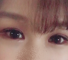 ผ่าตัดทำตาสองชั้นแล้วดวงตาเปลี่ยนไปเลย ♥