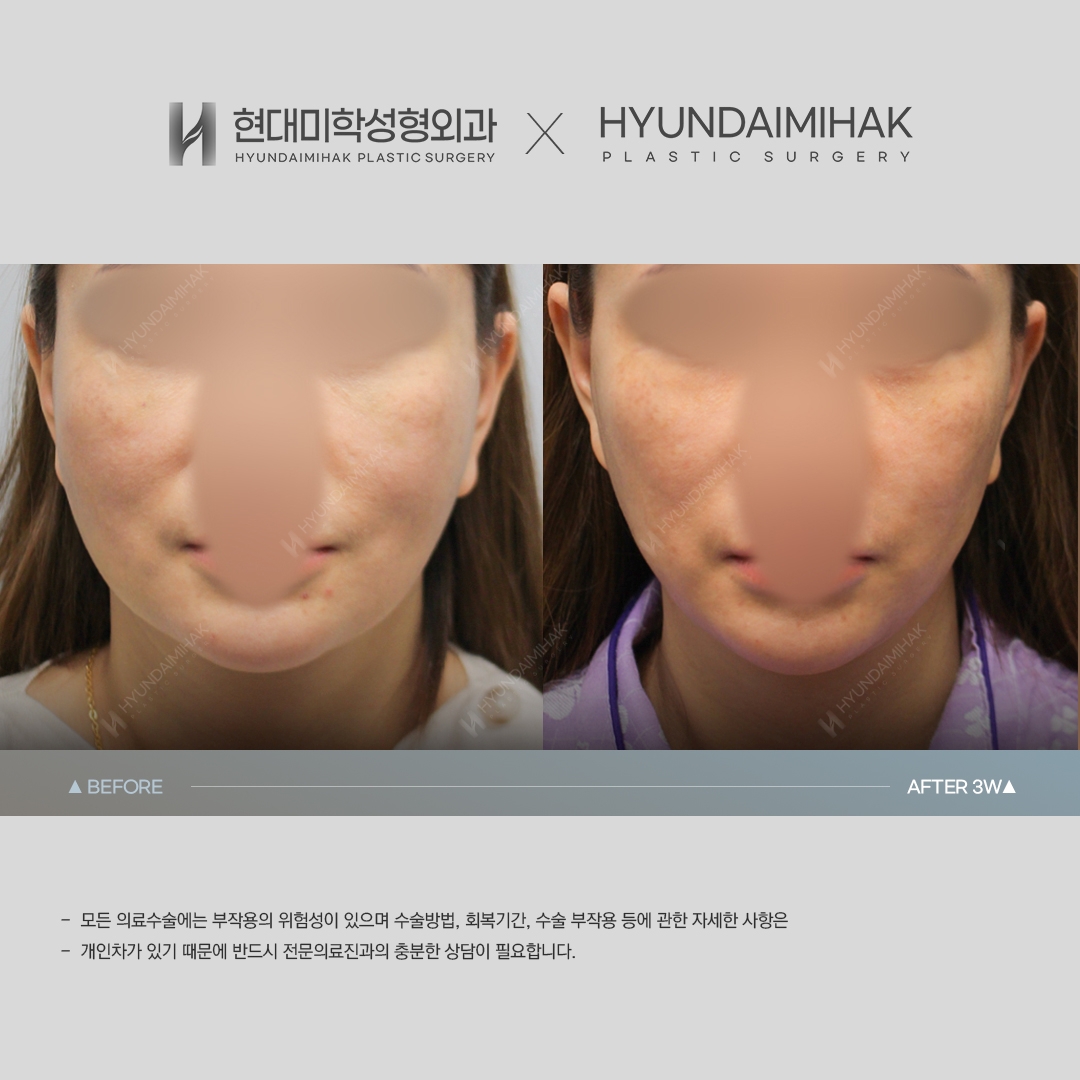 [ศัลยกรรมหน้าเด็ก] ร้อยไหม 3 สัปดาห์