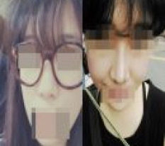 มีสันจมูกที่ไม่เคยมีแล้ว ดูเป็นคนขึ้นมาเลยค่ะ ฮ่าๆ