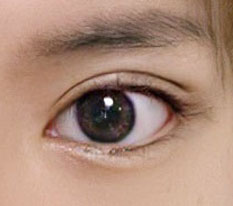 ผ่าตัดตาซ้ำ + เปิดหัวตา 1 เดือน คุณหมอเก่งมากจริงๆ