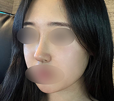 ได้จมูกสวยธรรมชาติแต่ดูเด่น