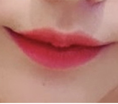 ทำศัลยกรรมยกมุมปากแล้วภาพลักษณ์เปลี่ยนไปมากเลยค่ะ ㅎㅎ
