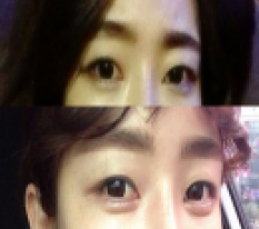 หลังฉีดฟิลเลอร์ กลายเป็นคนน่ารัก >3<