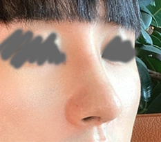 แก้จมูกโหนกแล้ว คนบอกว่าดูเป็นผู้ชายขึ้นมาก