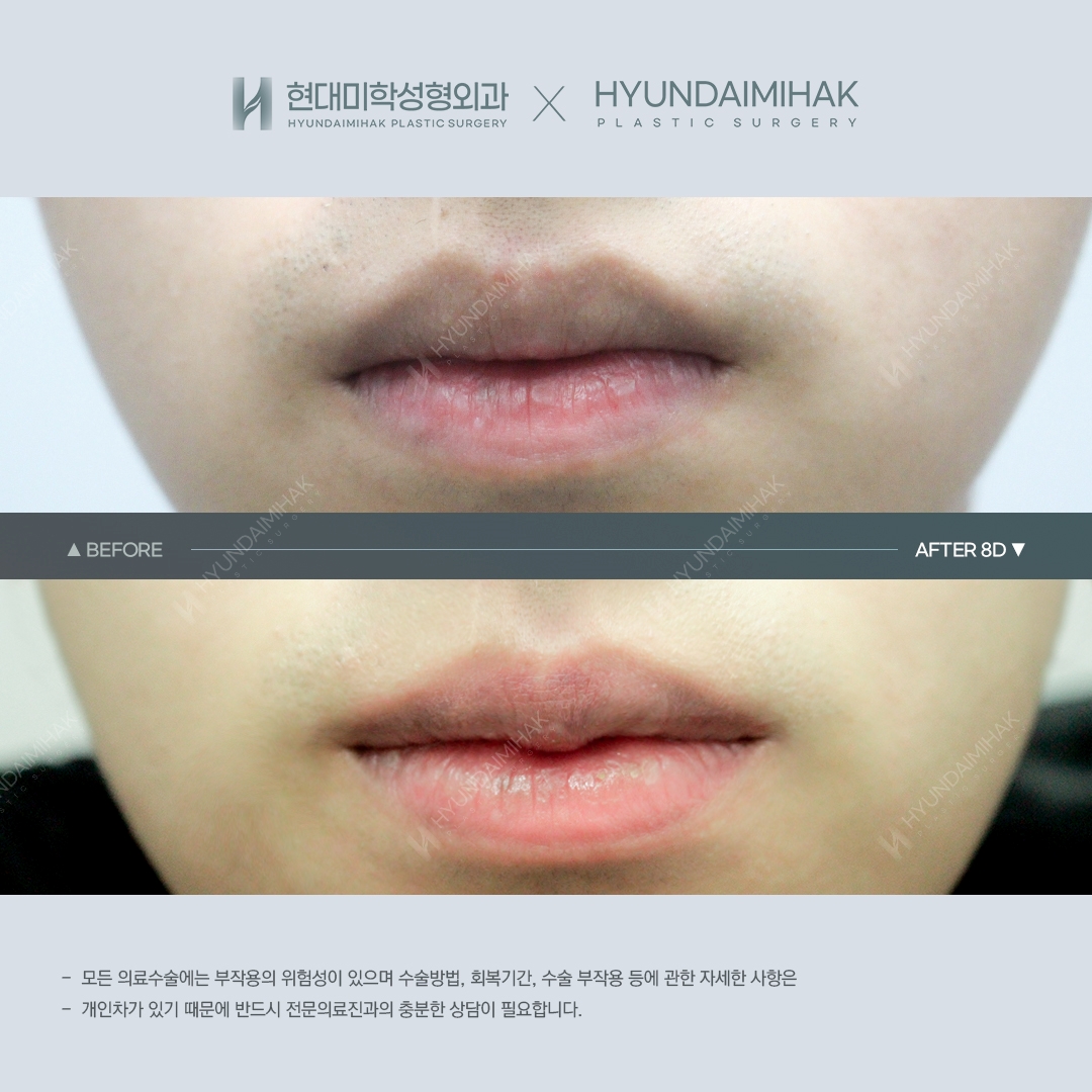 [ศัลยกรรมริมฝีปาก] ศัลยกรรมริมฝีปากคิวปิด วันที่ 8