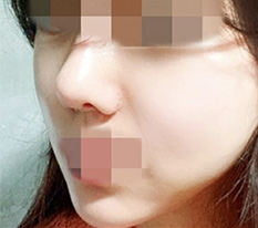 ทำศัลยกรรมโครงหน้ามาค่ะ มารีวิว ㅎㅎ