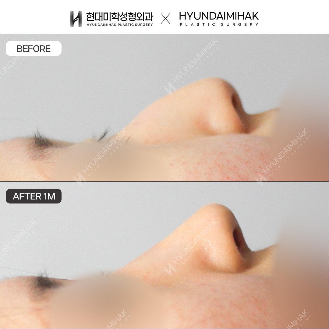 [ศัลยกรรมแก้จมูกฮัมพ์] สันจมูก + ปลายจมูก หลังทำ 1 เดือน
