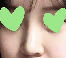 คนที่กำลังกังวลเรื่องทำจมูก~!!!!!! จะให้พูดอะไรอีก