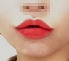 ลดร่องใต้จมูก+มุมปาก