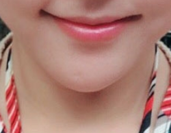 I Chose Surgery Instead of Mouth-Corner Filler!!