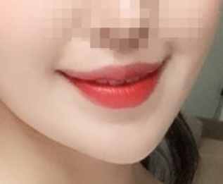 รีวิวผ่าตัดยกมุมปาก!!!!