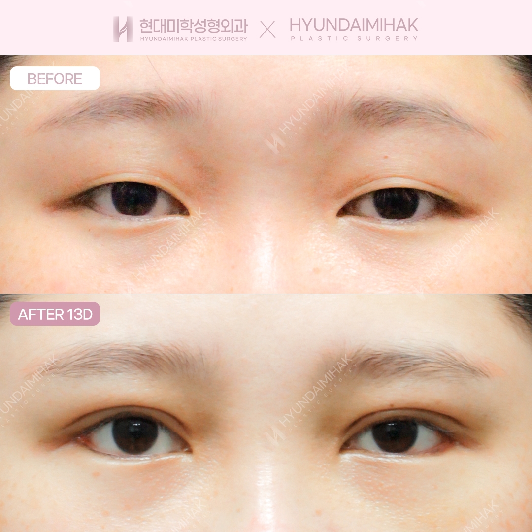 กรีดตาสองชั้น + ปรับกล้ามเนื้อตา + เปิดหางตาแบบดูอัล
