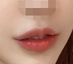 เขียนรีวิวเป็นที่ระลึกหลังผ่าตัดมุมปาก ㅎ