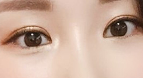 Double-Eyelid Surgery Review
