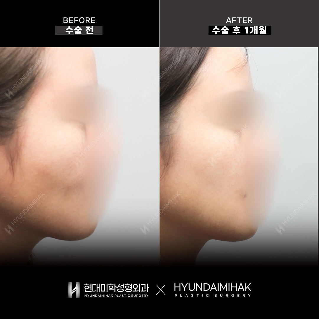 Facial Fat KILL (ฉีดปรับกรอบหน้า) ครบ 1 เดือน