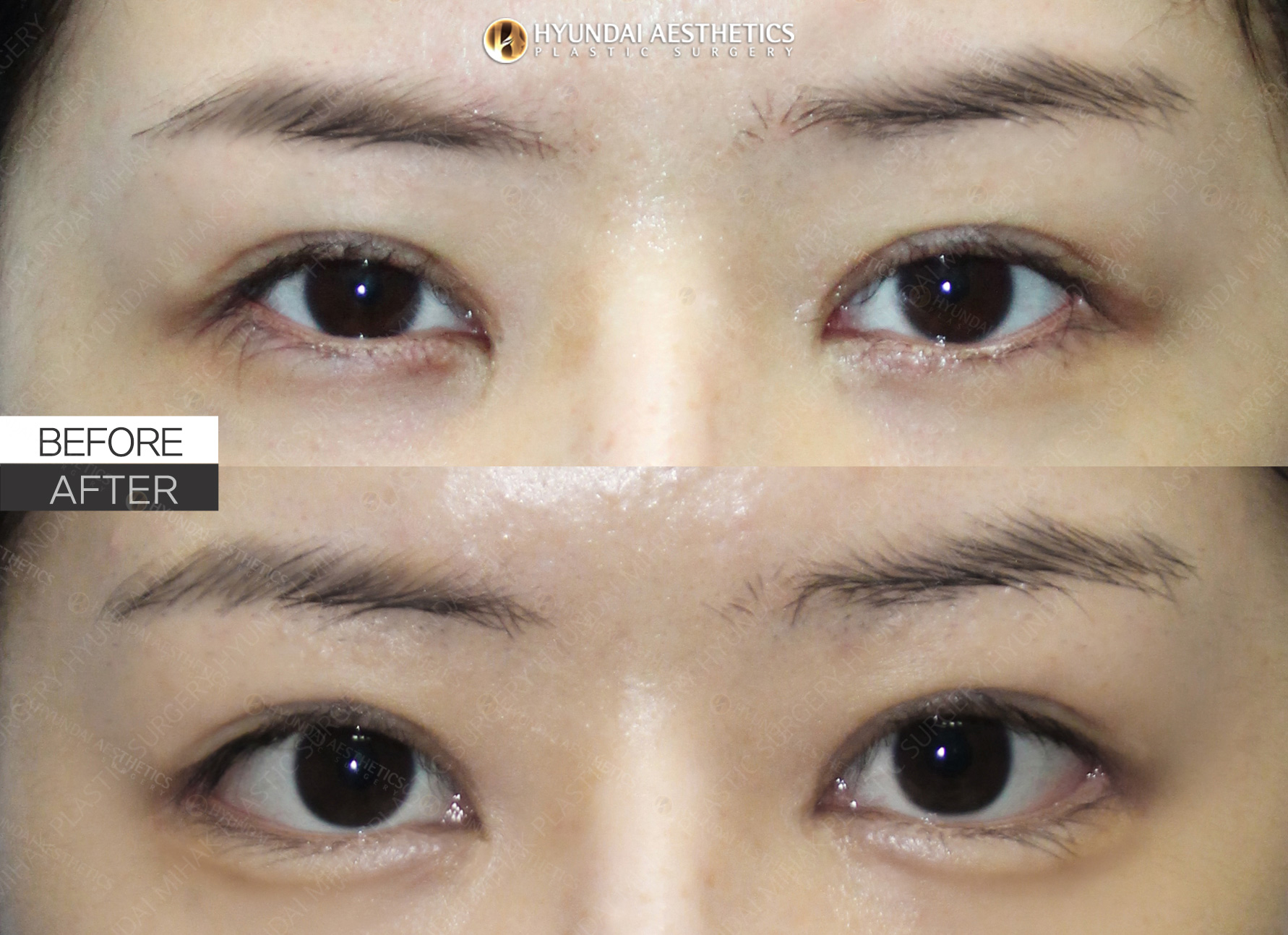 แก้ไขตา (ฟื้นฟูหัวตา, เปิดหางตา, เปิดขอบตาล่าง) + แก้กล้ามเนื้อตา ครบ 1 เดือน
