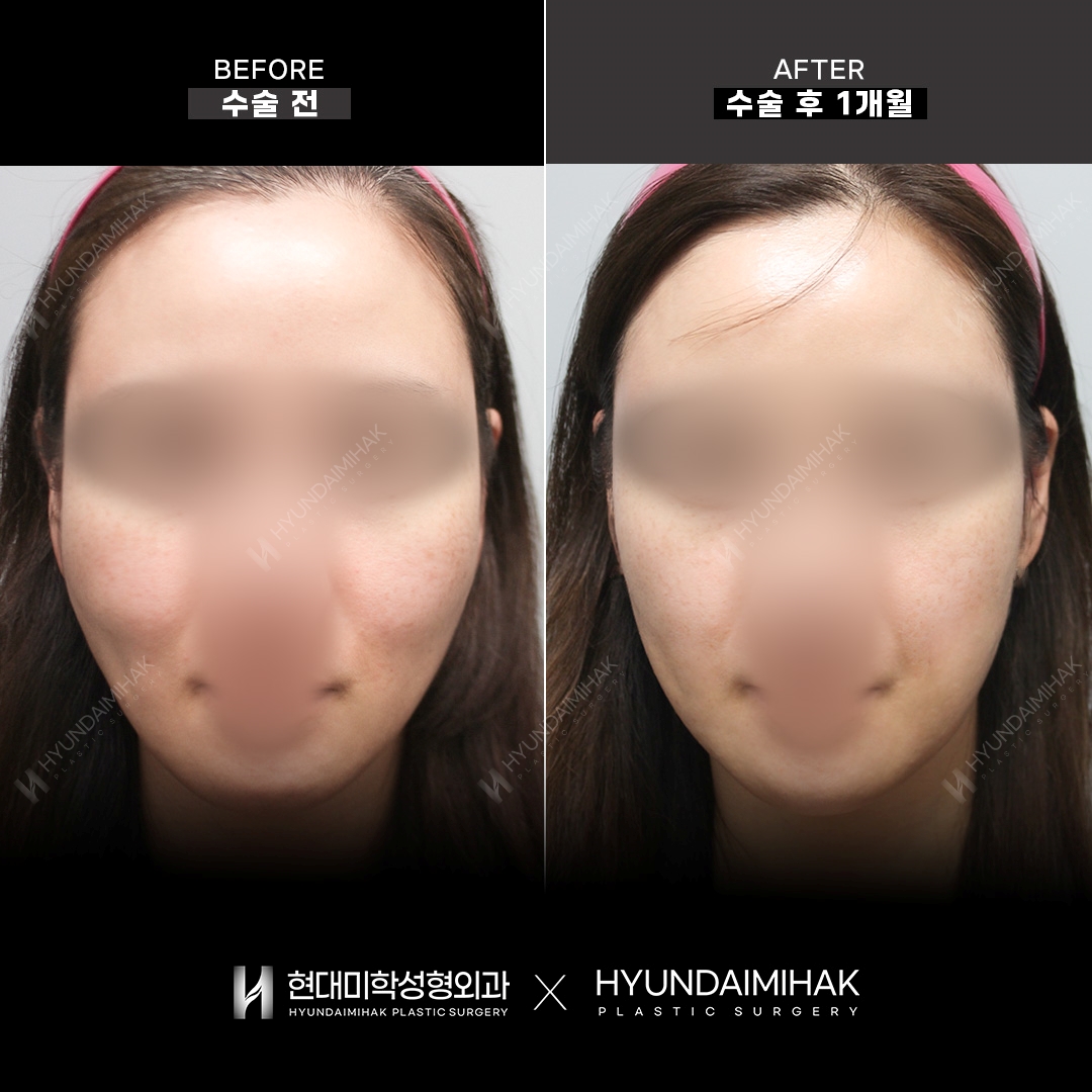 Facial Fat KILL (ฉีดปรับกรอบหน้า) ครบ 1 เดือน