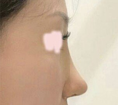 โพสต์รีวิวผ่าตัดจมูก — คิดยังไงบ้างคะ??