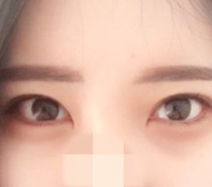 ผ่าตัดหางตาและเปลือกตาล่าง!