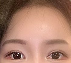 ยกหน้าผากครบ 3 เดือนค่ะ