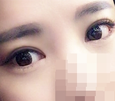 กรีดตา+แก้กล้ามเนื้อตา+เปิดหัว หาง และใต้ตา