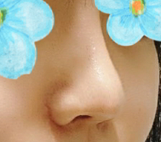 พอใจสุดๆ กับการแก้จมูก☆