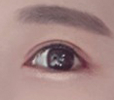 พอใจมากกับศัลยกรรมตา