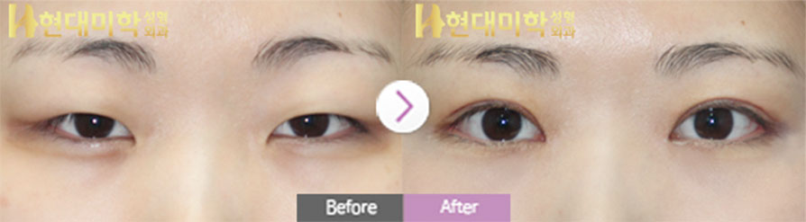 ตาแบบกรีด, ปรับกล้ามเนื้อตา, เปิดหัวตา, เปิดหางตาและเปิดใต้ตา