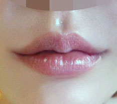 ทุกคนมาทำผ่าตัดยกมุมปากแทนการฉีดฟิลเลอร์กันเถอะนะคะ