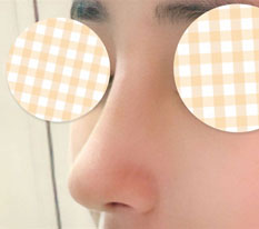 ดีใจที่เอาไหมhikoออกแล้วผ่าตัดจมูก